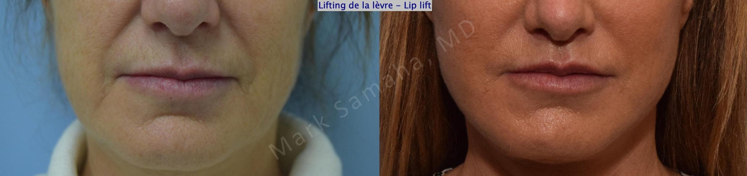 Before & After Lip Lift / Lifting de la lèvre supérieure Case 168 Front View in Mount Royal, QC