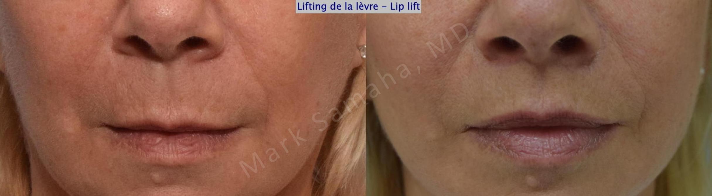 Before & After Lip Lift / Lifting de la lèvre supérieure Case 169 Front View in Mount Royal, QC