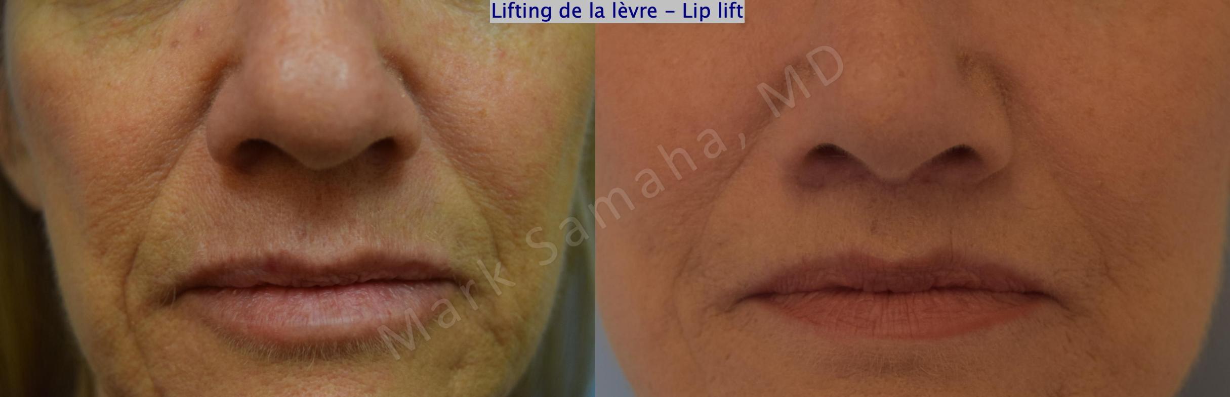 Before & After Lifting de la lèvre supérieure / Lip Lift  Case 170 Front View in Mount Royal, QC