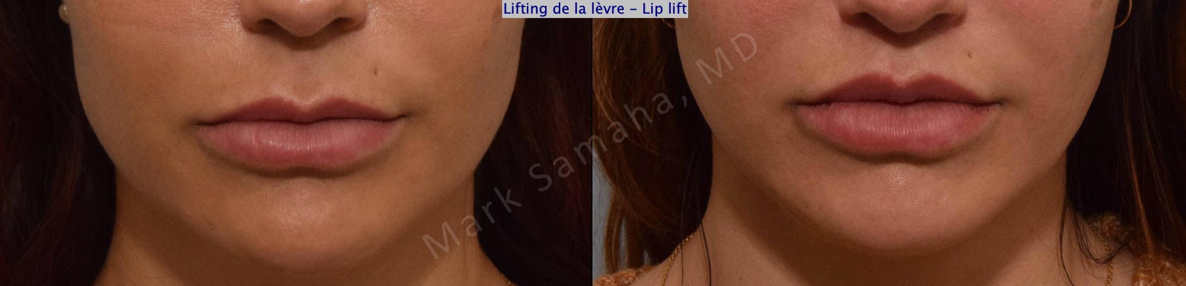 Before & After Lip Lift / Lifting de la lèvre supérieure Case 171 Front View in Mount Royal, QC