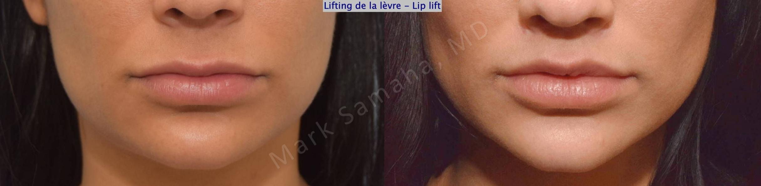 Before & After Lip Lift / Lifting de la lèvre supérieure Case 172 Front View in Mount Royal, QC