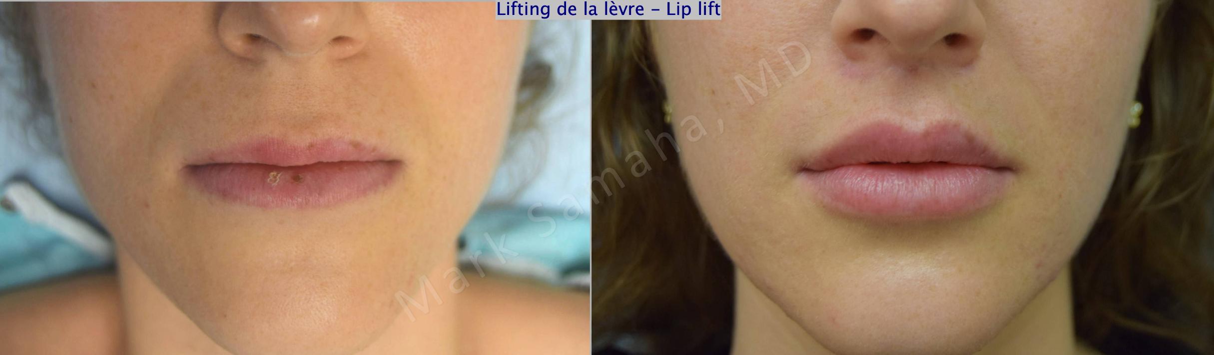 Before & After Lip Lift / Lifting de la lèvre supérieure Case 174 Front View in Mount Royal, QC