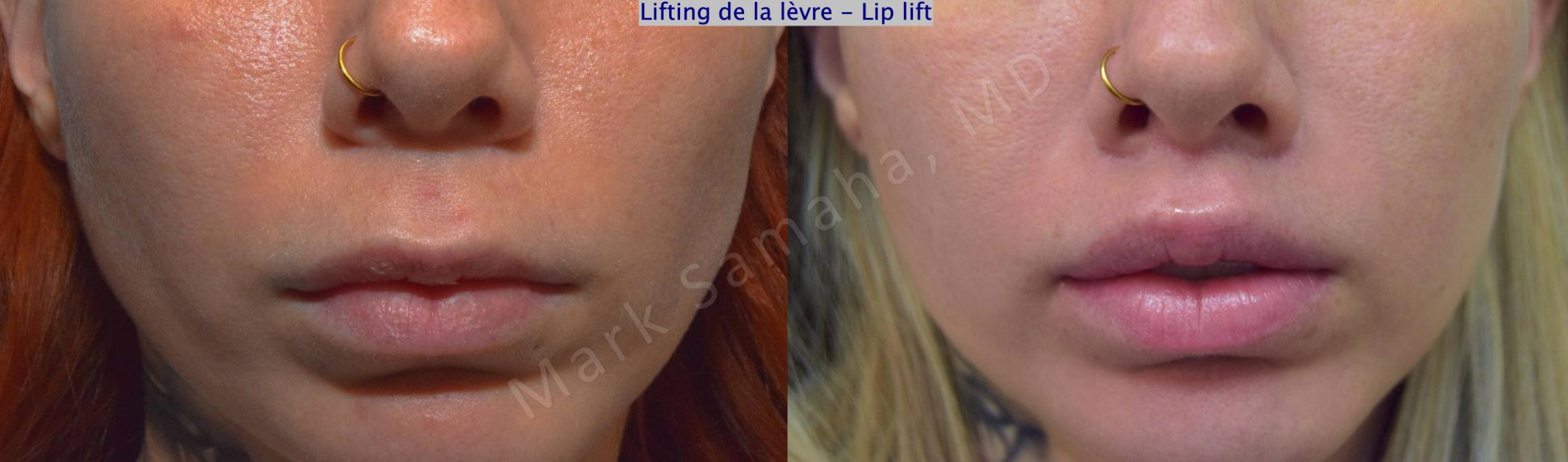 Before & After Lip Lift / Lifting de la lèvre supérieure Case 176 Front View in Mount Royal, QC