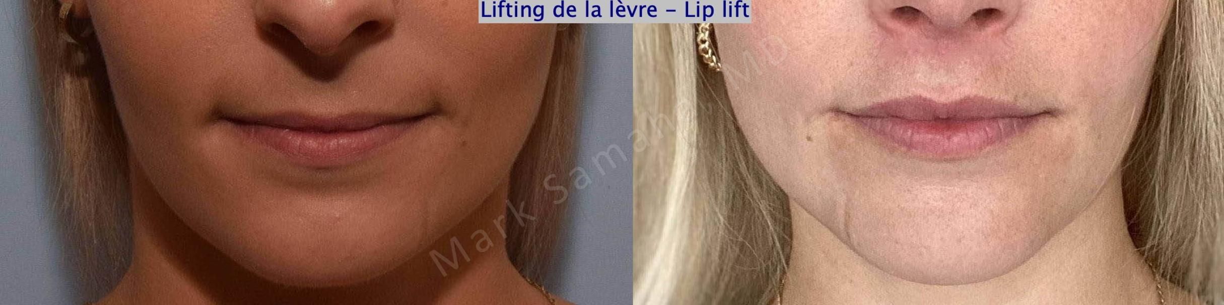 Before & After Lip Lift / Lifting de la lèvre supérieure Case 177 Front View in Mount Royal, QC