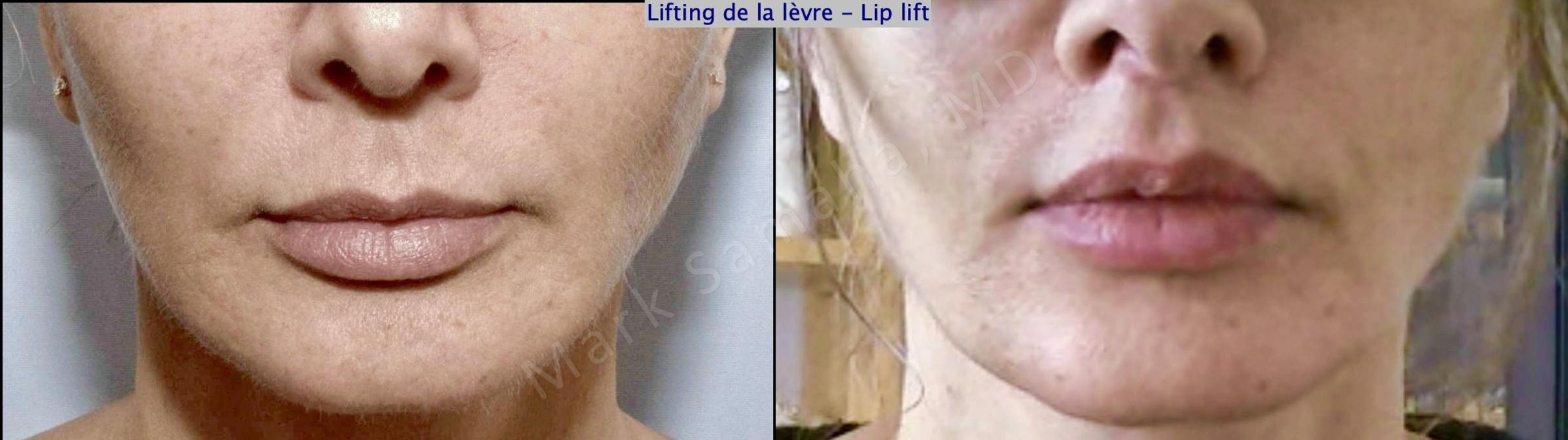 Before & After Lip Lift / Lifting de la lèvre supérieure Case 178 Front View in Mount Royal, QC