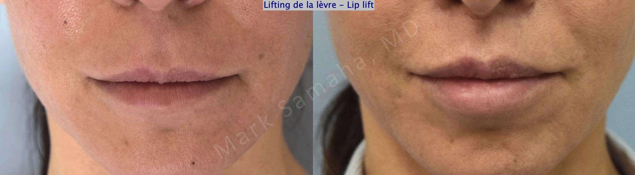 Before & After Lip Lift / Lifting de la lèvre supérieure Case 179 Front View in Mount Royal, QC
