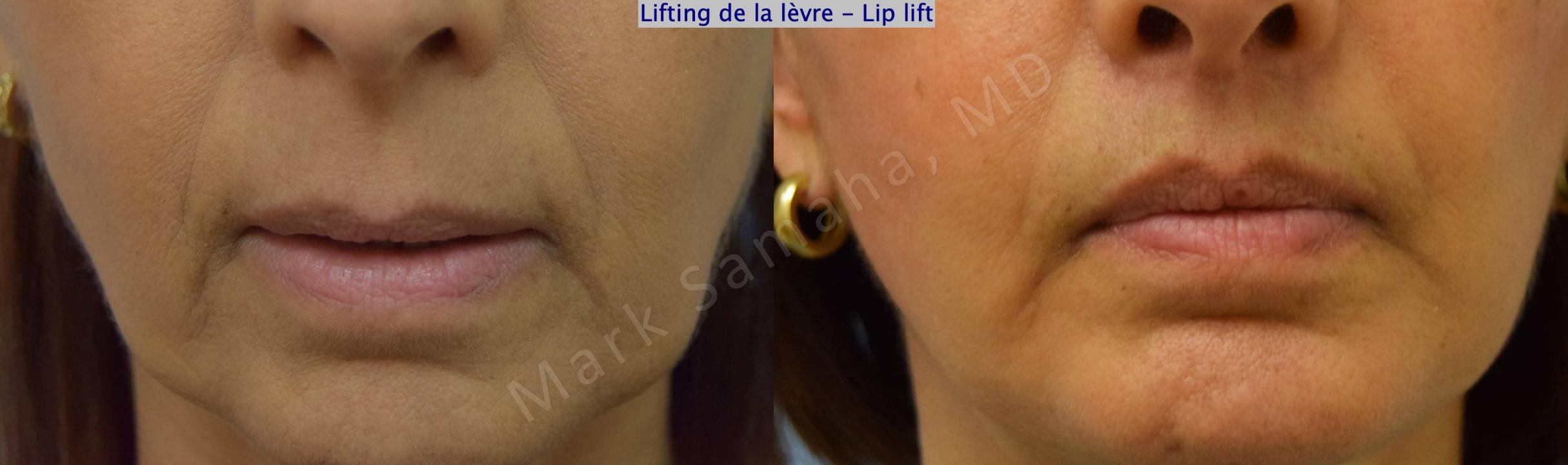 Before & After Lip Lift / Lifting de la lèvre supérieure Case 196 Front View in Mount Royal, QC