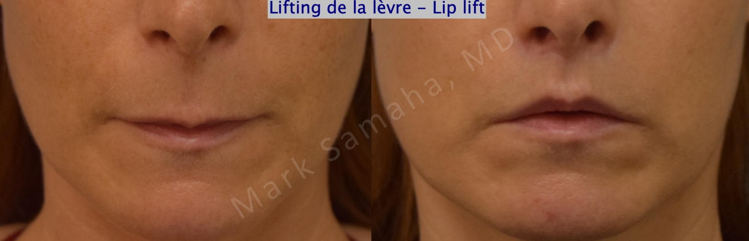 Before & After Lip Lift / Lifting de la lèvre supérieure Case 197 Front View in Mount Royal, QC