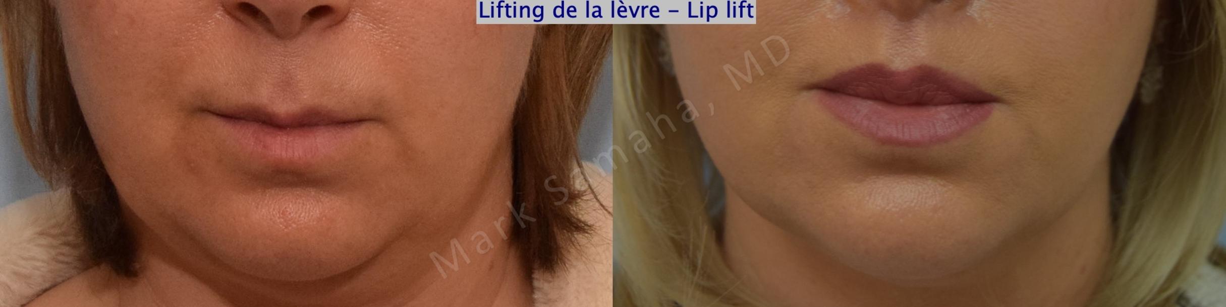 Before & After Lip Lift / Lifting de la lèvre supérieure Case 198 Front View in Mount Royal, QC