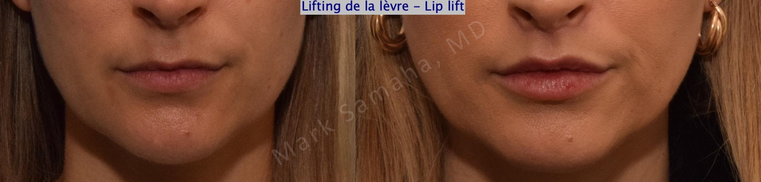 Before & After Lip Lift / Lifting de la lèvre supérieure Case 199 Front View in Mount Royal, QC