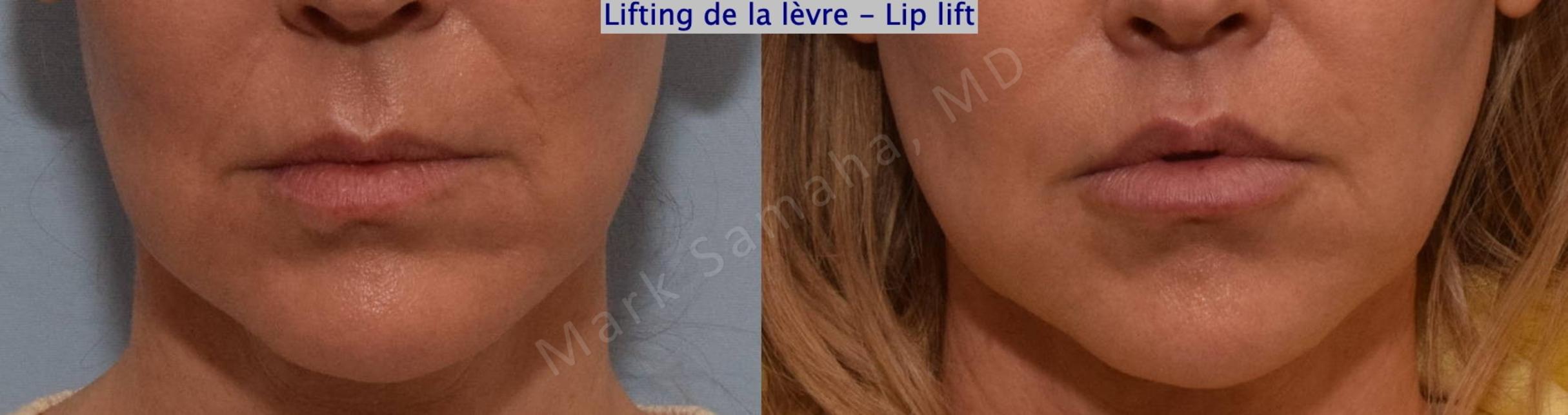 Before & After Lip Lift / Lifting de la lèvre supérieure Case 201 Front View in Mount Royal, QC