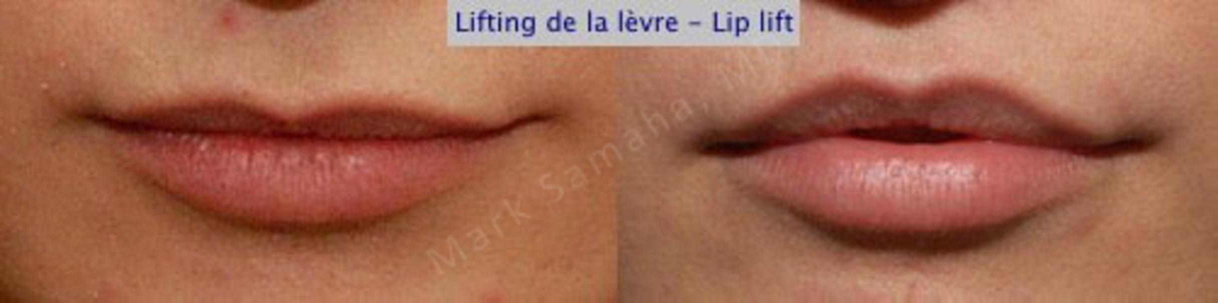 Before & After Lip Lift / Lifting de la lèvre supérieure Case 23 View #1 View in Mount Royal, QC