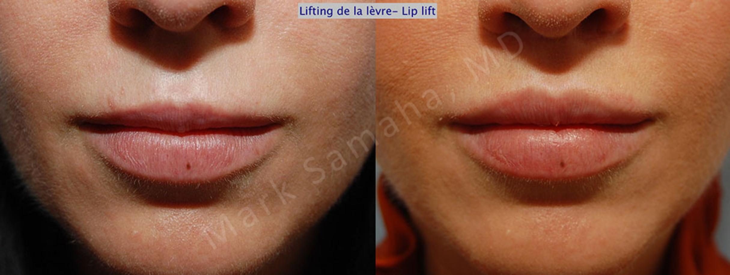 Before & After Lip Lift / Lifting de la lèvre supérieure Case 27 View #1 View in Mount Royal, QC