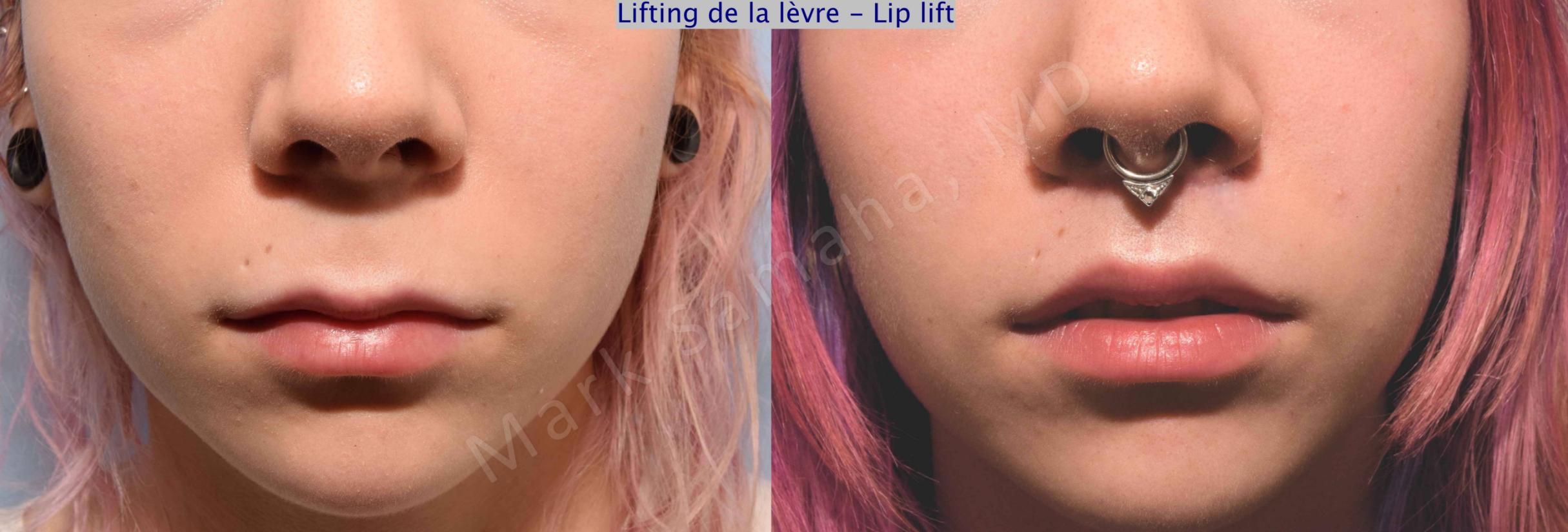 Before & After Lifting de la lèvre supérieure / Lip Lift  Case 71 View #1 View in Mount Royal, QC