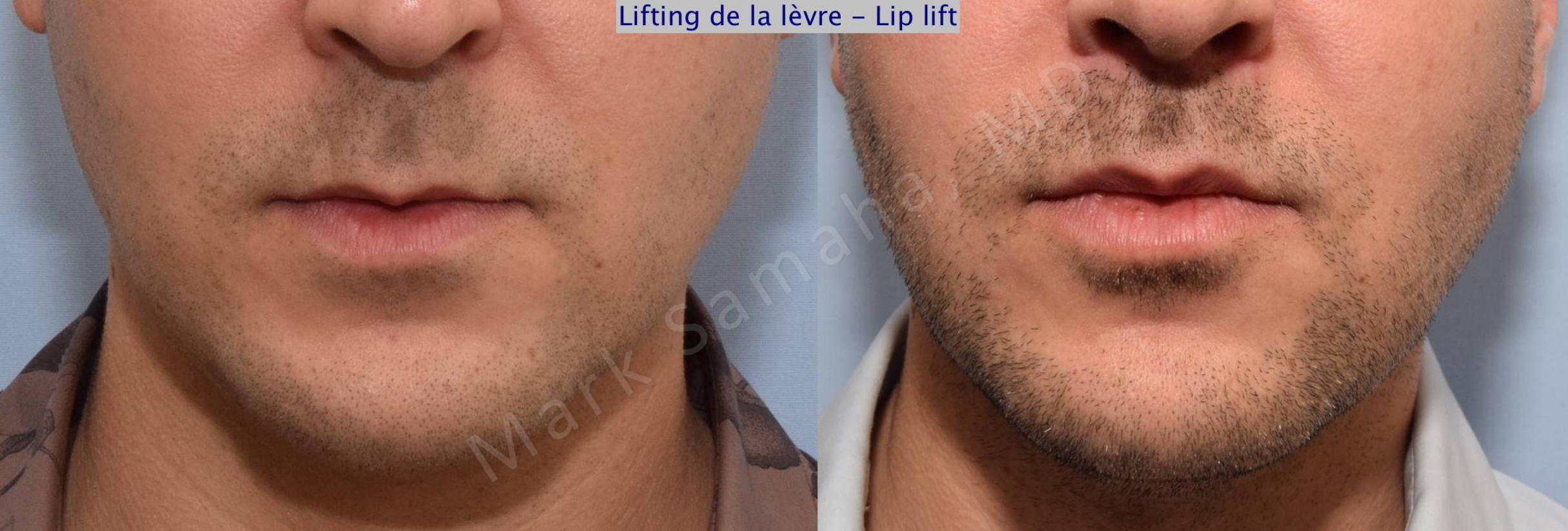 Before & After Lip Lift / Lifting de la lèvre supérieure Case 72 View #1 View in Mount Royal, QC