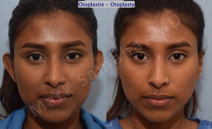 Before & After Otoplastie / Ear Surgery Case 180 Front View in Montreal, QC