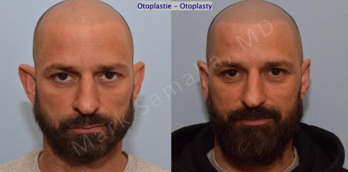 Before & After Otoplastie / Ear Surgery Case 200 Front View in Montreal, QC