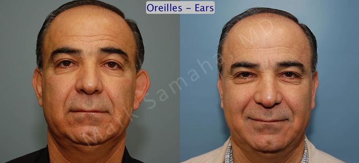 Before & After Otoplastie / Ear Surgery Case 30 View #1 View in Mount Royal, QC