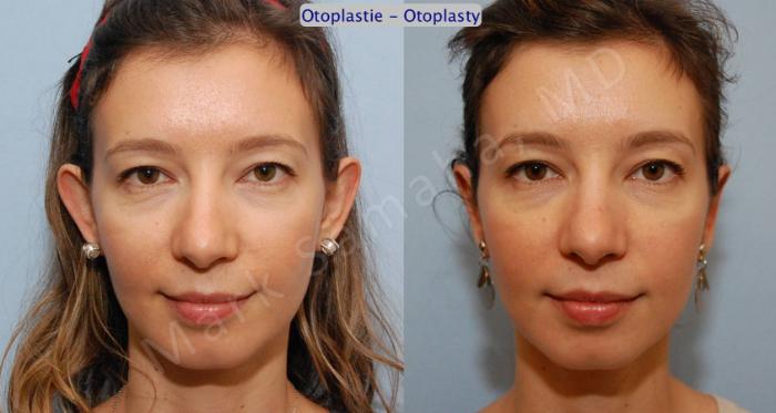 Before & After Otoplastie / Ear Surgery Case 74 View #1 View in Montreal, QC