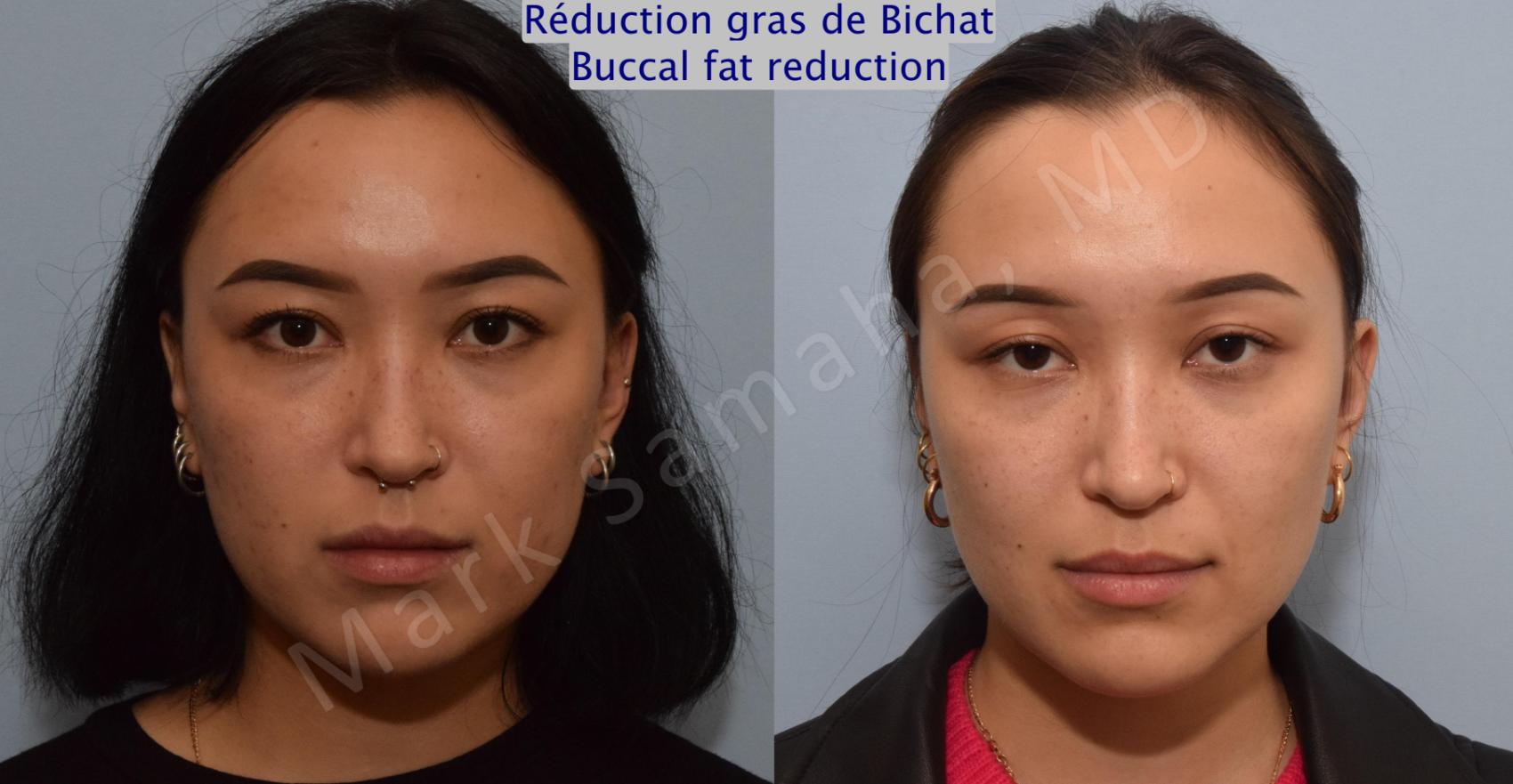 Before & After Réduction des Boules de Bichat / Buccal Fat Removal Case 155 Front View in Montreal, QC