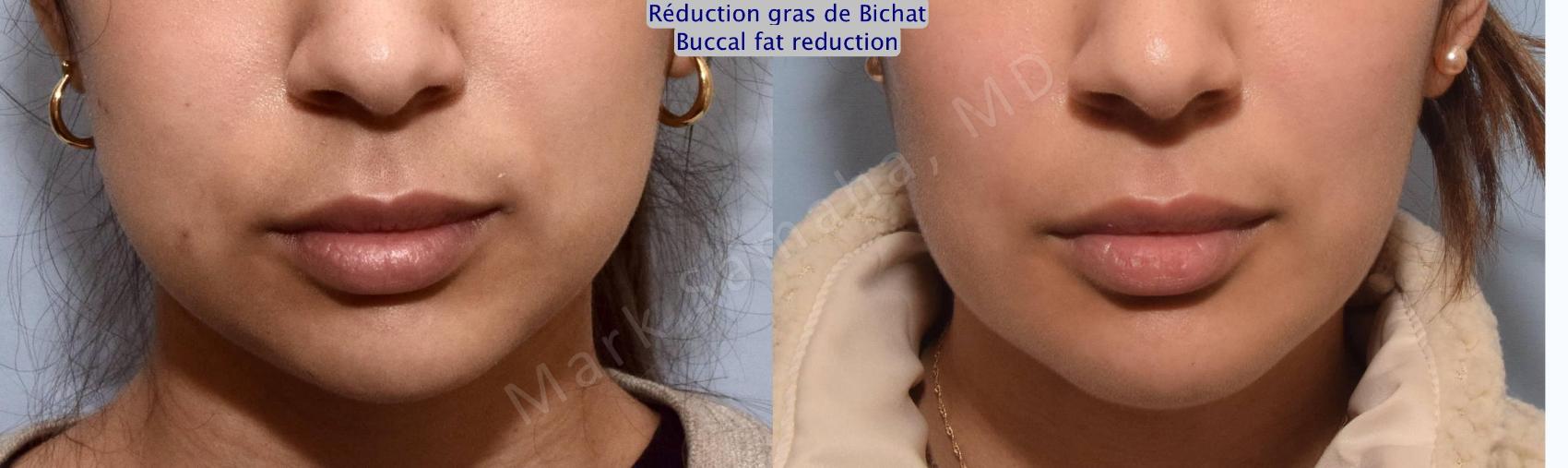 Before & After Réduction des Boules de Bichat / Buccal Fat Removal Case 157 Front View in Montreal, QC