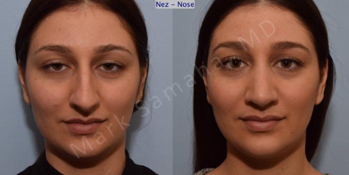 Before & After Rhinoplastie / Rhinoplasty Case 105 View #1 View in Montreal, QC