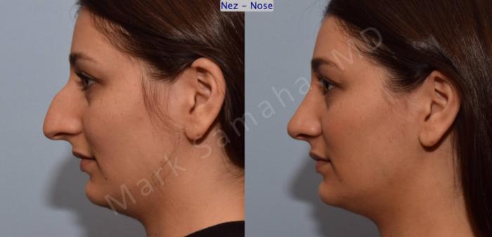 Before & After Rhinoplastie / Rhinoplasty Case 105 View #2 View in Montreal, QC