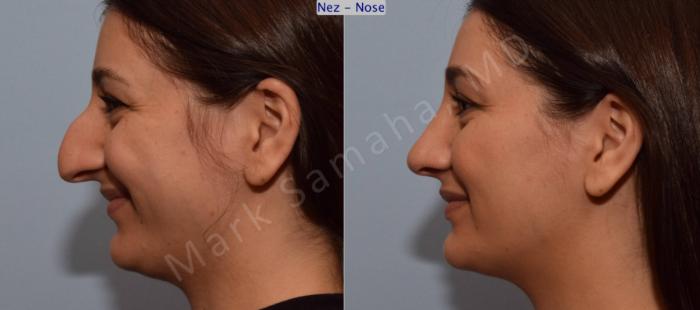 Before & After Rhinoplastie / Rhinoplasty Case 105 View #3 View in Montreal, QC