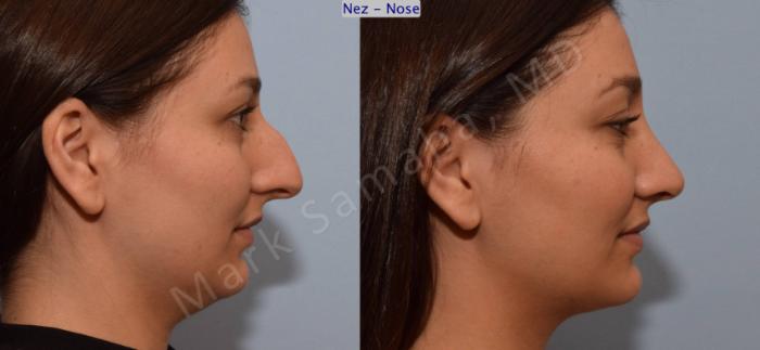 Before & After Rhinoplastie / Rhinoplasty Case 105 View #4 View in Montreal, QC