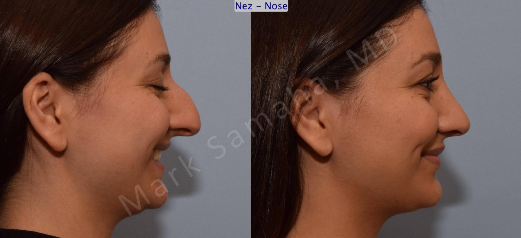 Before & After Rhinoplastie / Rhinoplasty Case 105 View #5 View in Montreal, QC