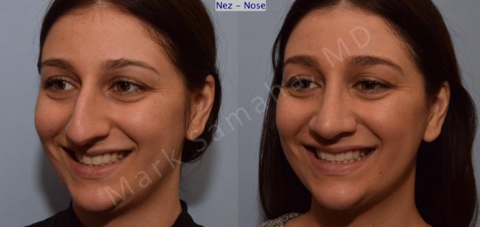Before & After Rhinoplastie / Rhinoplasty Case 105 View #7 View in Montreal, QC