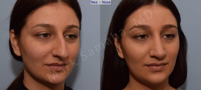Before & After Rhinoplastie / Rhinoplasty Case 105 View #8 View in Montreal, QC