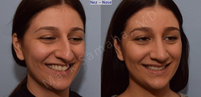 Before & After Rhinoplastie / Rhinoplasty Case 105 View #9 View in Montreal, QC