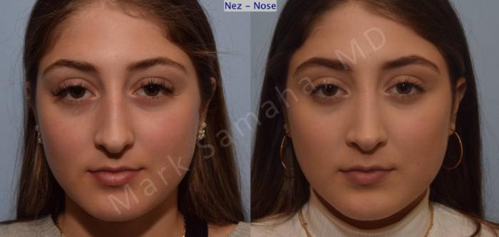 Before & After Rhinoplastie / Rhinoplasty Case 106 View #1 View in Montreal, QC