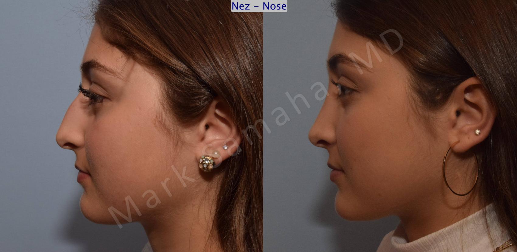 Before & After Rhinoplastie / Rhinoplasty Case 106 View #2 View in Mount Royal, QC