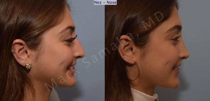 Before & After Rhinoplastie / Rhinoplasty Case 106 View #5 View in Mount Royal, QC