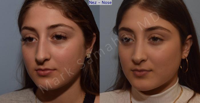 Before & After Rhinoplastie / Rhinoplasty Case 106 View #6 View in Montreal, QC