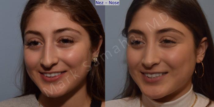 Before & After Rhinoplastie / Rhinoplasty Case 106 View #7 View in Montreal, QC