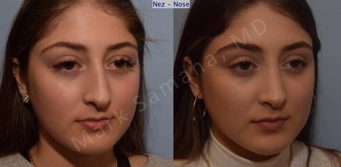 Before & After Rhinoplastie / Rhinoplasty Case 106 View #8 View in Mount Royal, QC