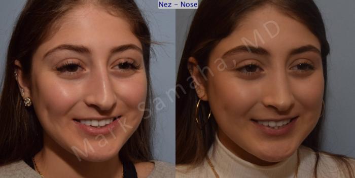 Before & After Rhinoplastie / Rhinoplasty Case 106 View #9 View in Montreal, QC