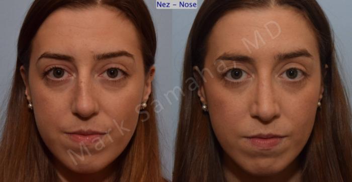 Before & After Rhinoplastie / Rhinoplasty Case 107 View #1 View in Montreal, QC