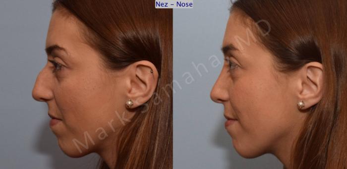 Before & After Rhinoplastie / Rhinoplasty Case 107 View #2 View in Montreal, QC