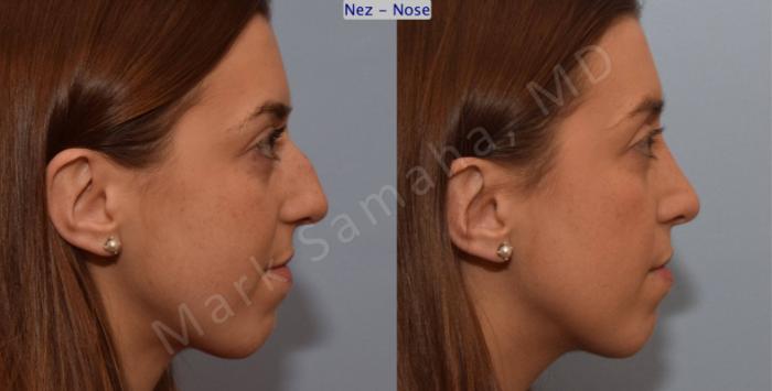 Before & After Rhinoplastie / Rhinoplasty Case 107 View #4 View in Montreal, QC