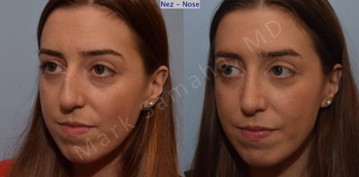 Before & After Rhinoplastie / Rhinoplasty Case 107 View #6 View in Montreal, QC