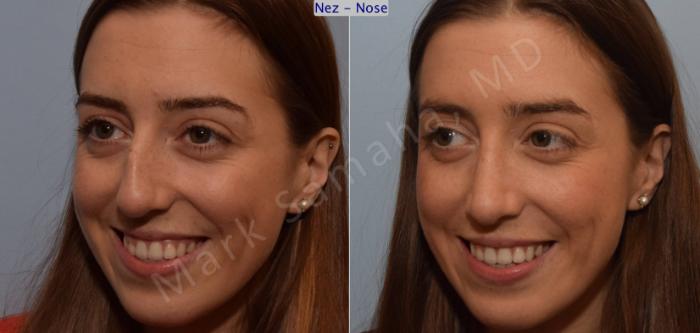 Before & After Rhinoplastie / Rhinoplasty Case 107 View #7 View in Montreal, QC
