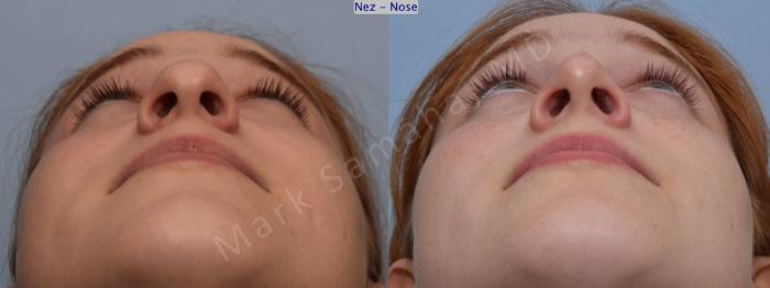Before & After Rhinoplastie / Rhinoplasty Case 108 View #2 View in Montreal, QC