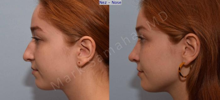 Before & After Rhinoplastie / Rhinoplasty Case 108 View #3 View in Montreal, QC