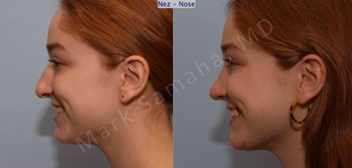 Before & After Rhinoplastie / Rhinoplasty Case 108 View #4 View in Montreal, QC
