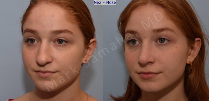 Before & After Rhinoplastie / Rhinoplasty Case 108 View #7 View in Montreal, QC