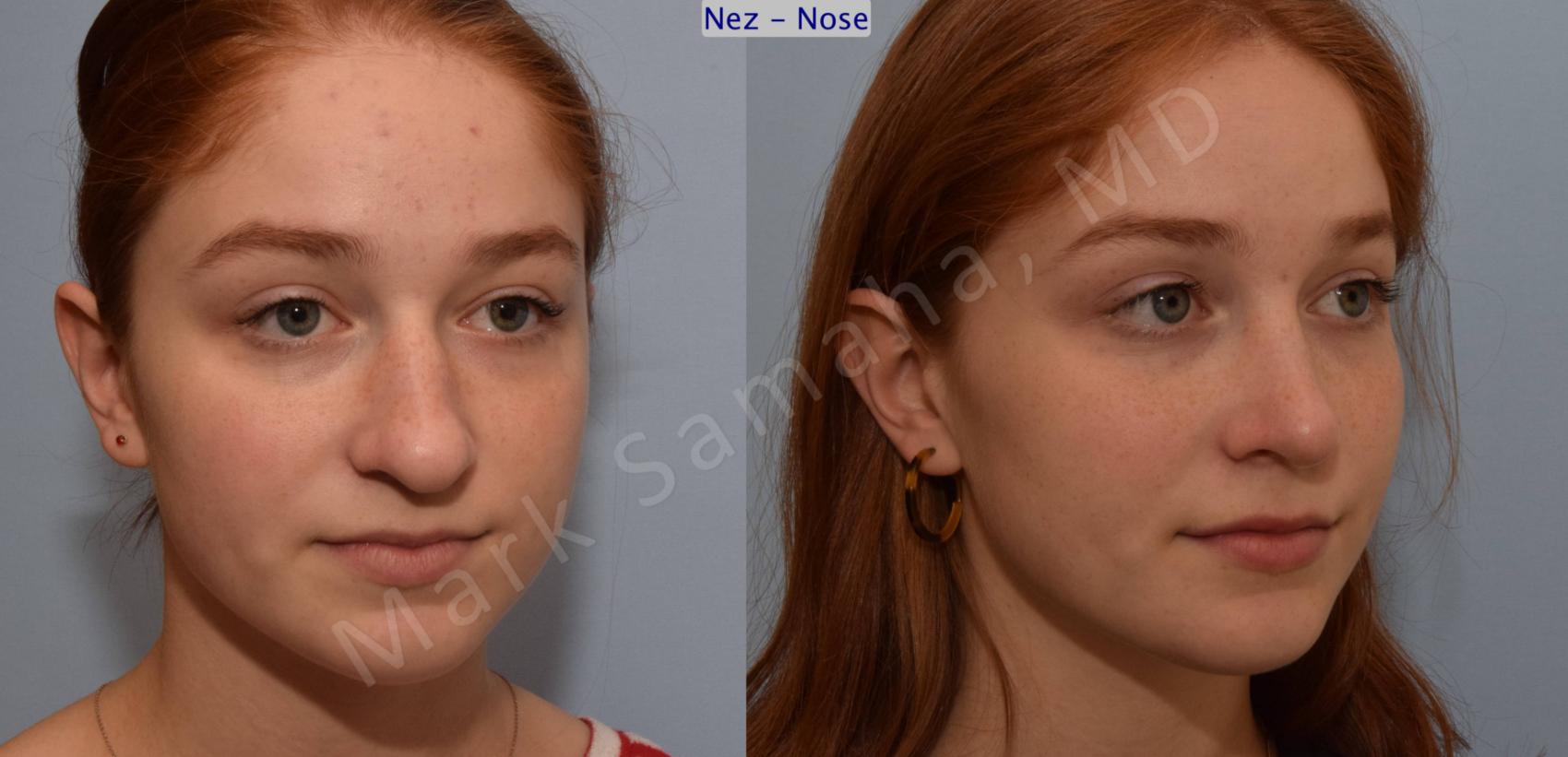Before & After Rhinoplastie / Rhinoplasty Case 108 View #8 View in Montreal, QC